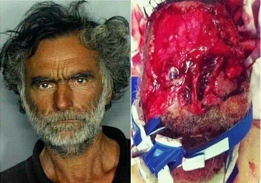 Ronald Poppo, before and after he was brutally attacked by the Miami Zombie Rudy Eugene.