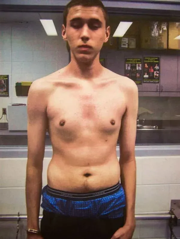 Tyler struggled all his life with weight and self-esteem issues. He was even put on HGH, human growth hormone, which you can see from the slight development of male breast in this photo.
