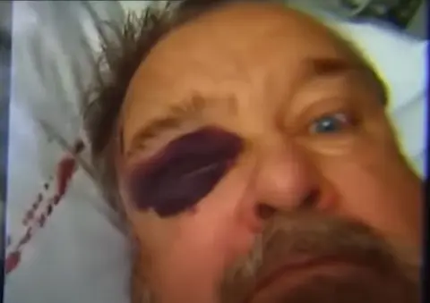 The convicted pedophile Wesley Hayes was beaten with a hammer. His eye is completely swollen shut.